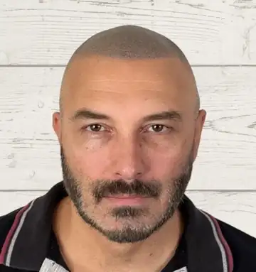 Domenico, TRICO DM, con la sua tricopigmentazione effetto rasato