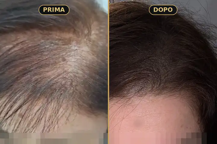 Prima e dopo una tricopigmentazione su diradamento femminile
