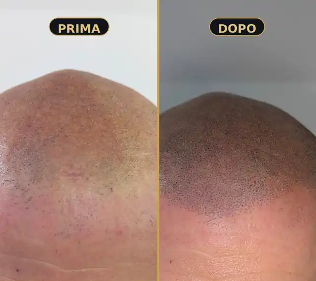 Prima e dopo un trattamento di tricopigmentazione Metodo DM sulla zona frontale